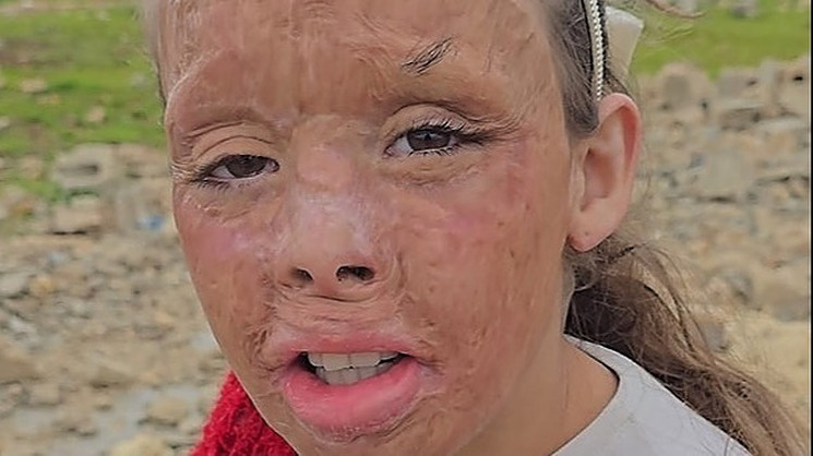 Help Lina Heal – A Cry for Support By Diaa slame